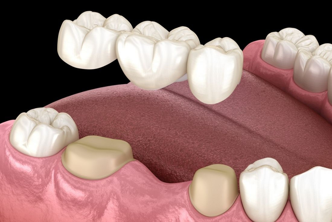 Bone Grafting