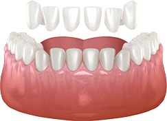 Dental Veneers