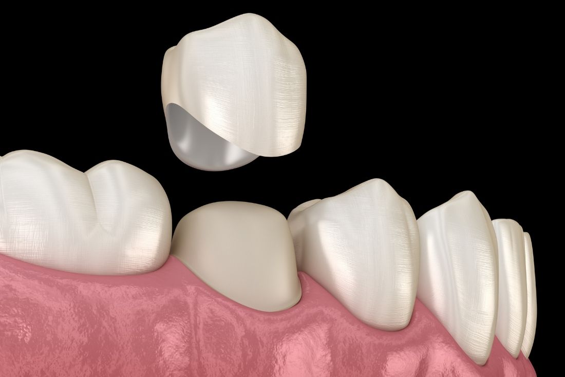 Dental Crowns Image