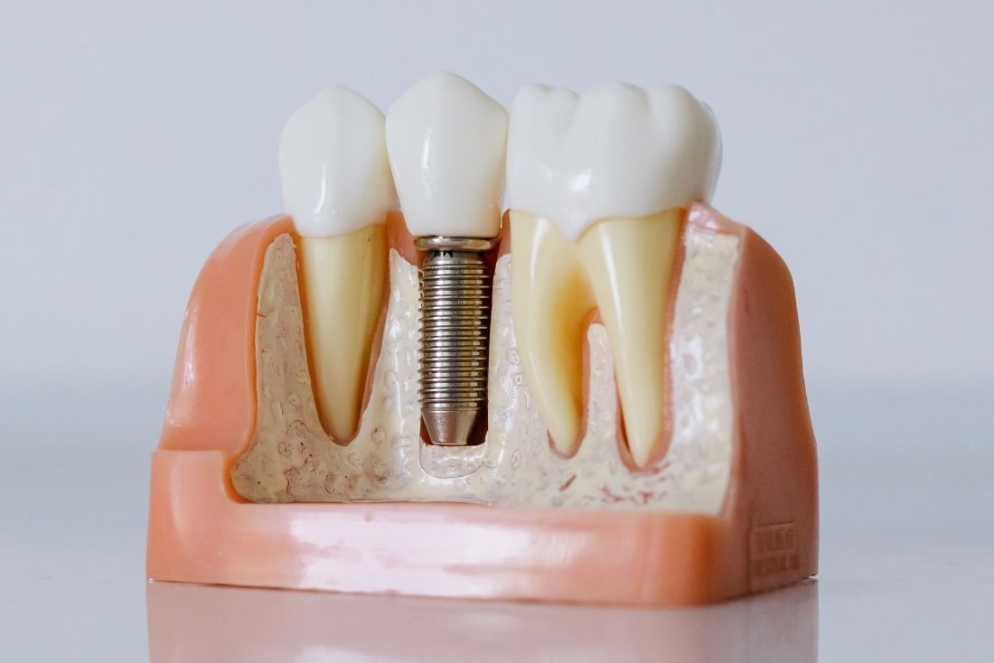 Dental Implants Image