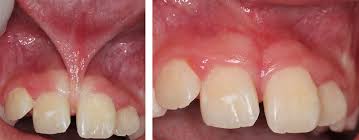 Frenectomy Image