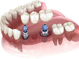 Implant Supported Bridge