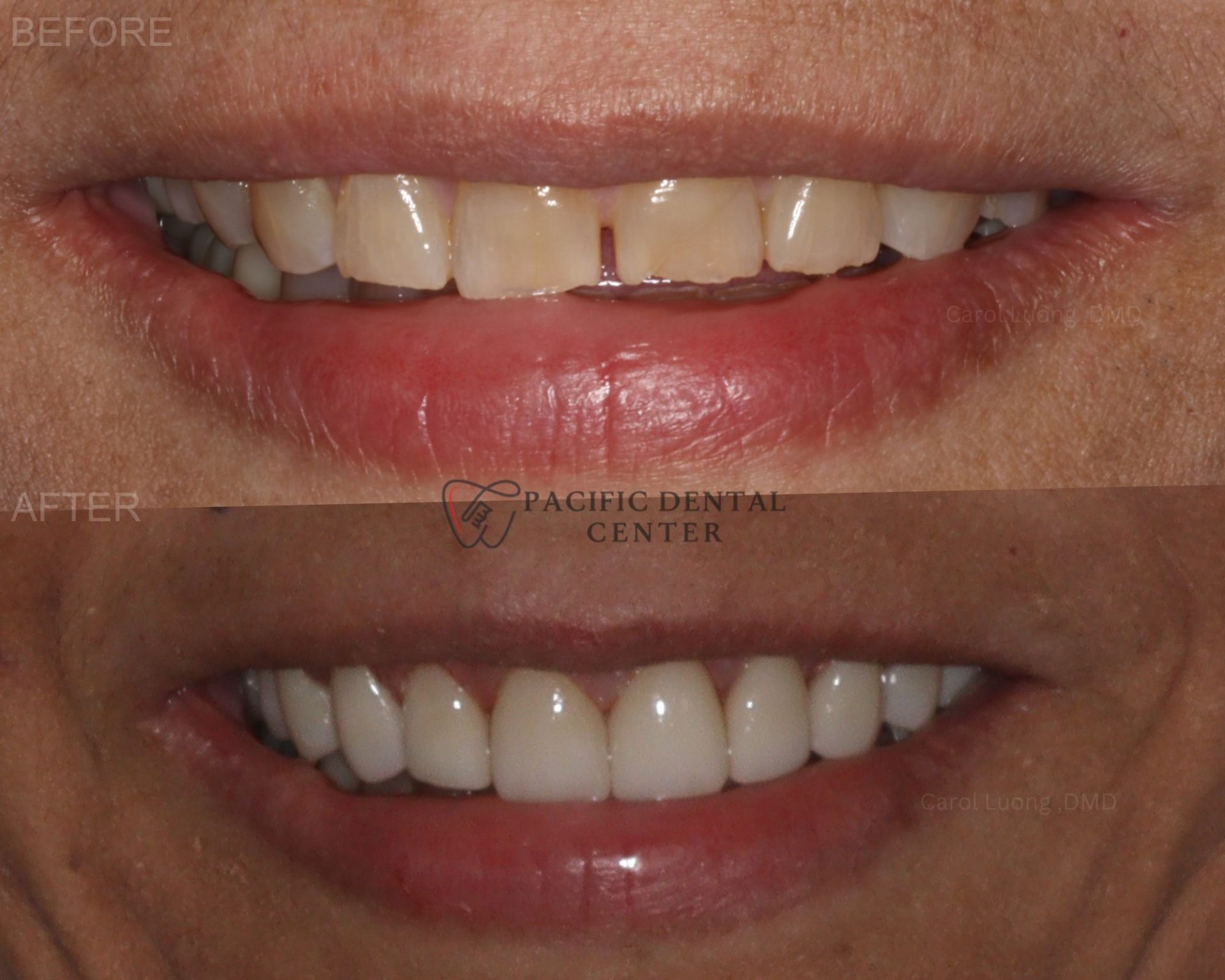 ESPERANZA Before and After