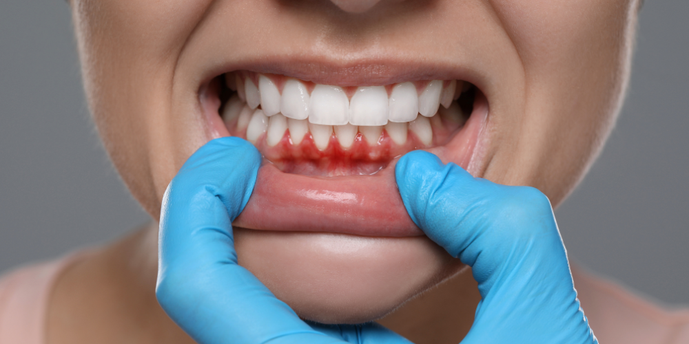 woman with bleeding gums
