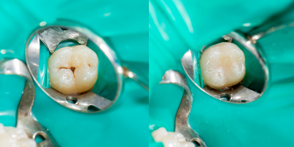 dental sealant before and after use on teeth